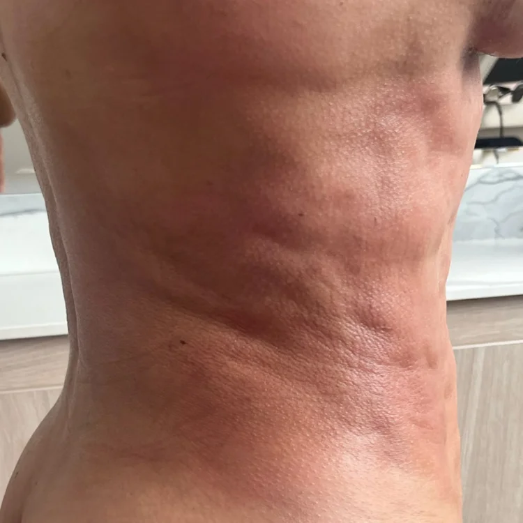 bolitas abdomen post lipo