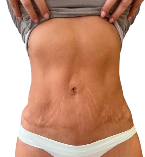 fibrosis abdomen